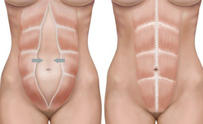 Diastasis Rektinin (Karın Kası Ayrılması): Bilmeniz Gereken Her Şey